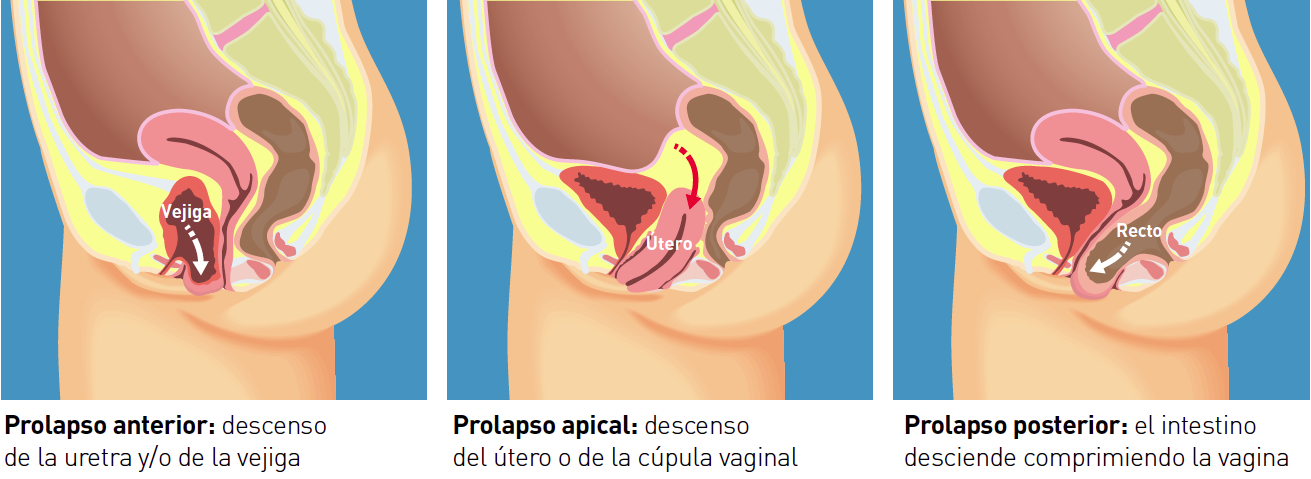 Él hacer clic Hazlo pesado Cirugía del Prolapso Genital | Dr. Gustavo Rebagliati